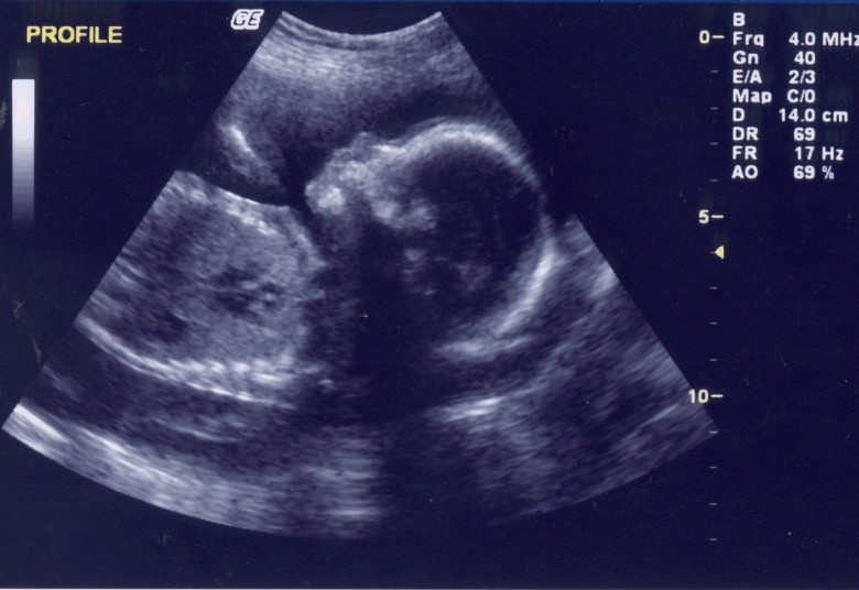 ultrasound of new baby